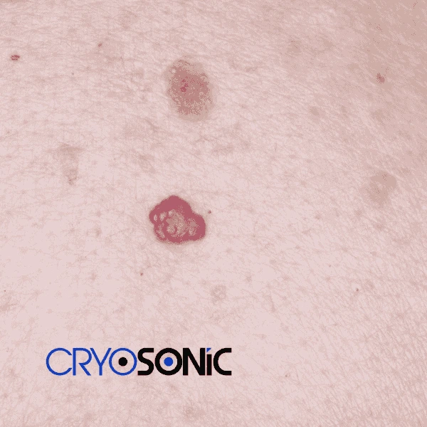 Looking for pain free cherry angioma removal treatment Shrewsbury? Call our team today! Shrewsbury