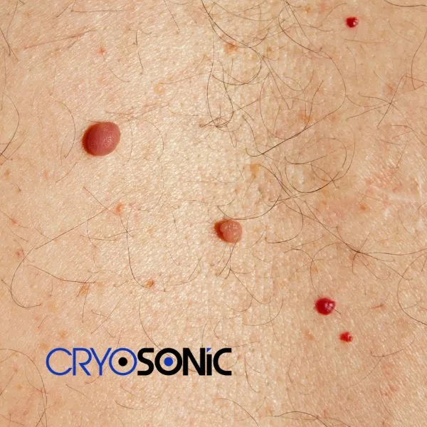 get cherry angioma removal treatment today! Shrewsbury