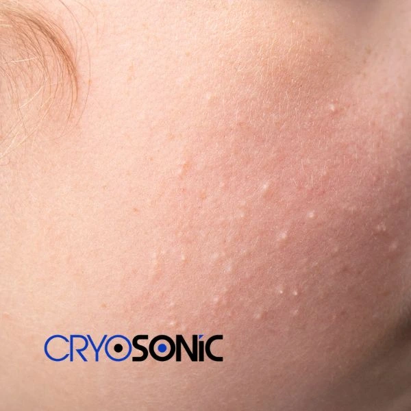 Are you looking for milia removal treatment? Contact our team today Shrewsbury