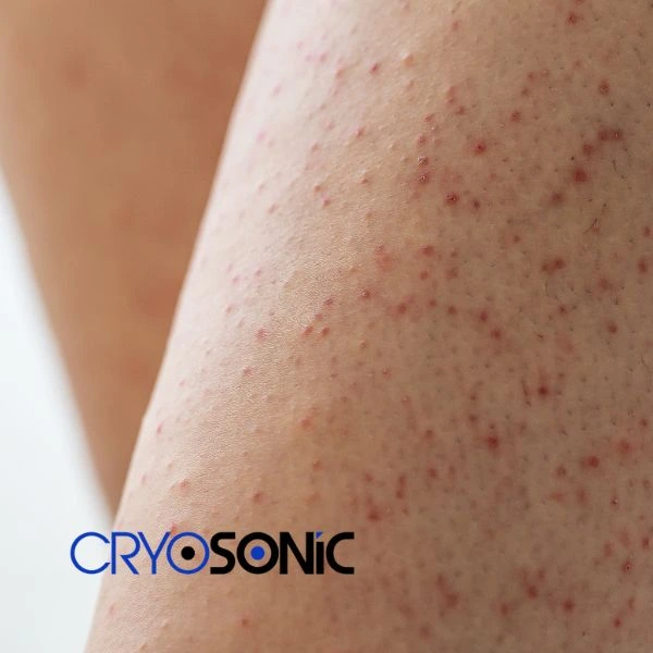 Looking for Seborrhoeic Keratosis removal Shrewsbury treatment? Call our consultants today in Shrewsbury