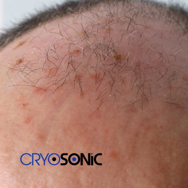 Access Seborrhoeic Keratosis removal from the comfort of your own home! Call us today in Shrewsbury
