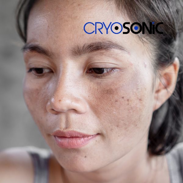 Ready to start age spots removal? Contact our team today in Shrewsbury