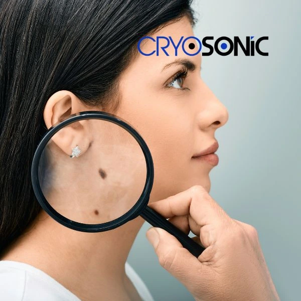 Do you want to learn more about benign moles removal treatment? Call our team today Shrewsbury