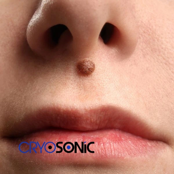Start your benign moles removal treatment today Shrewsbury