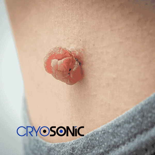 Book your skin tags removal Shrewsbury from comfort of your own home! Shrewsbury