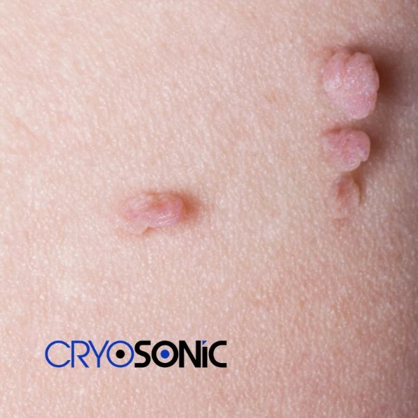 Are you looking for fast effect skin tag removal Shrewsbury? Book in NOW! Shrewsbury