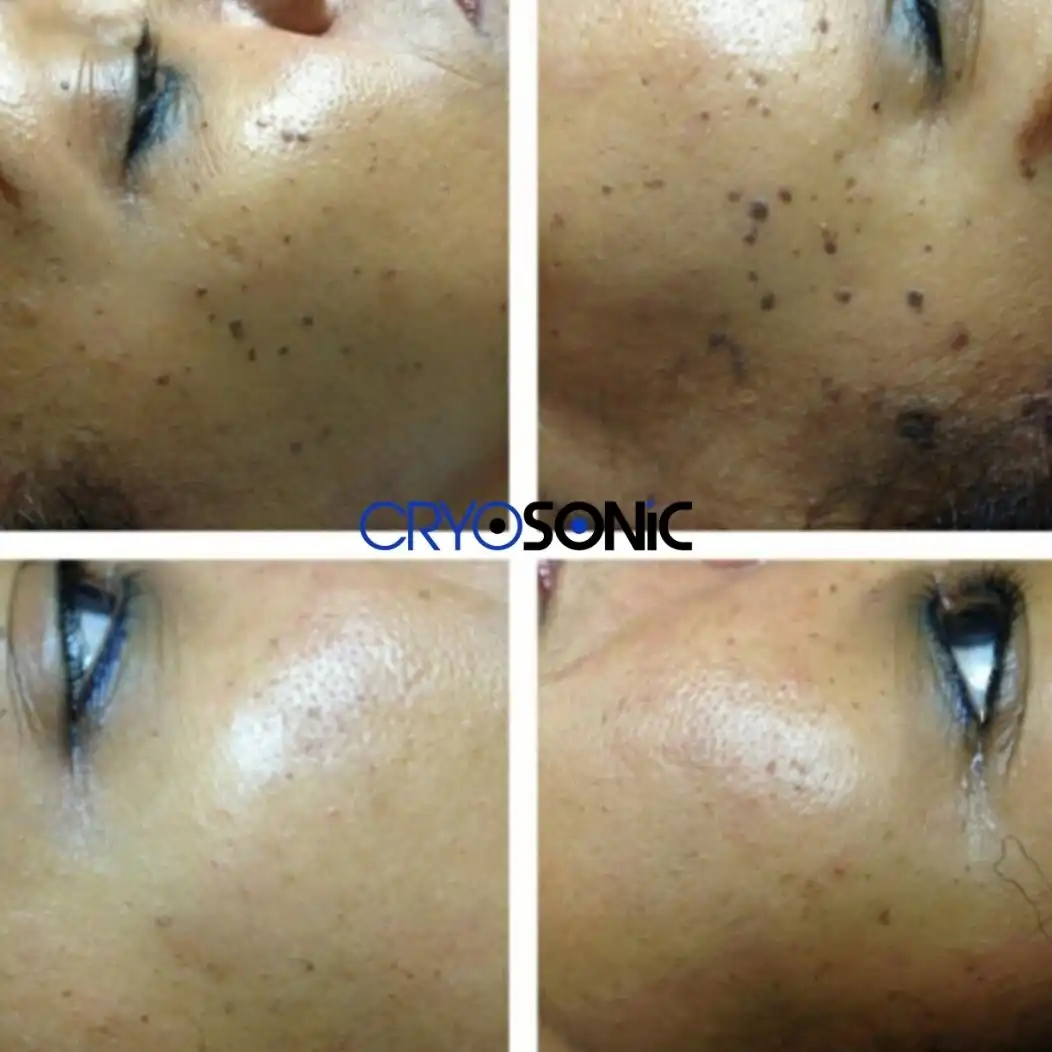 Why Skin Shows Pigmentation After Treatment Shrewsbury