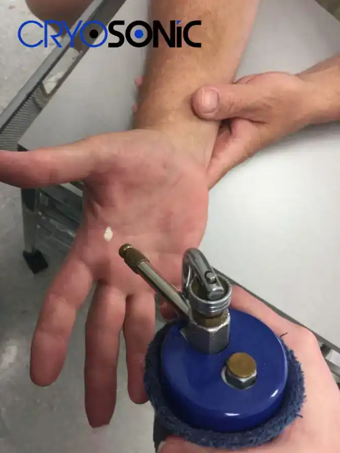 Temperature Differences: OTC vs Medical-Grade Cryotherapy Shrewsbury